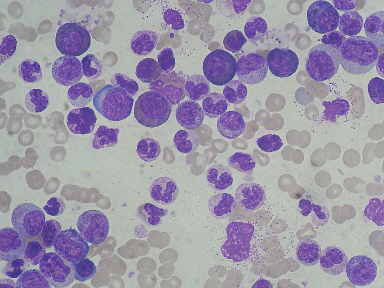 Blood from CML patient with higher number of granulocytes (dyed cells) by Paulo Henrique Orlandi Mourao