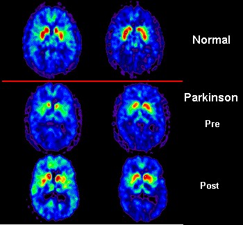 PET_scan_Parkinson Disease