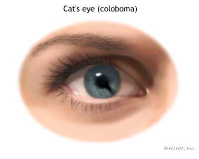 Coloboma with a more defined "keyhole" shape