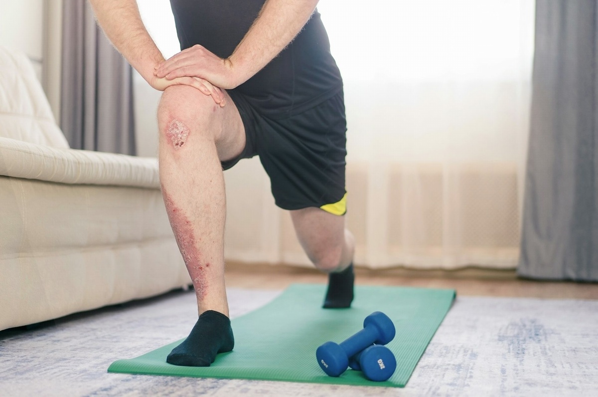 Man with psoriasis on leg does home exercises