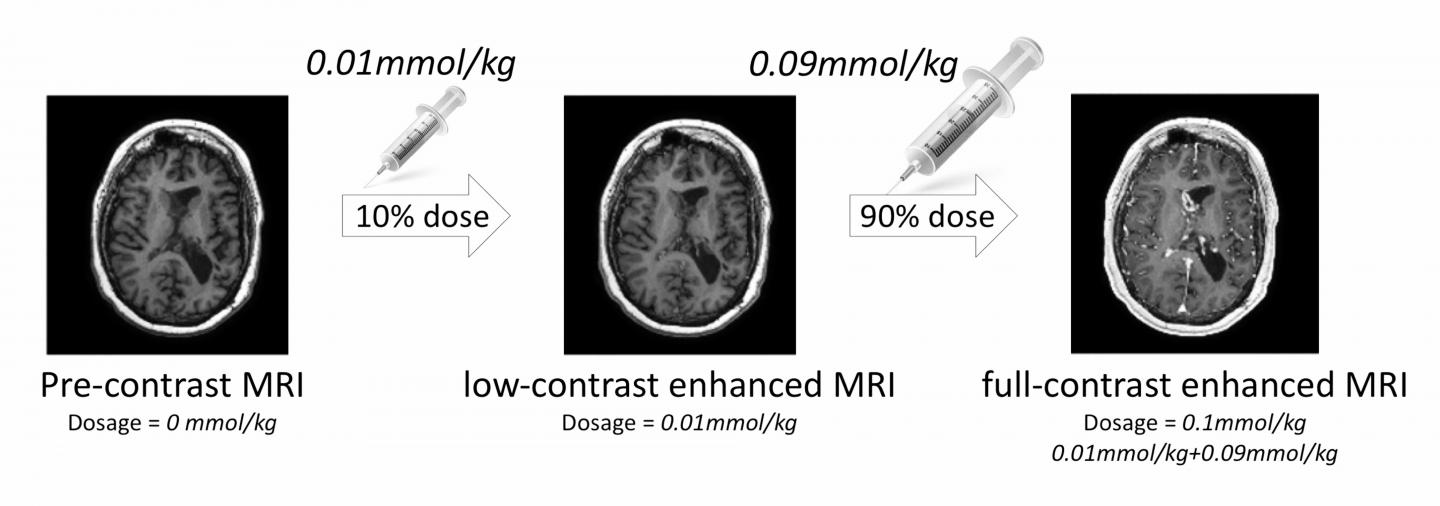 How To Reduce Gadolinium Heavy Metal Contrast Agent In MRI Using AI