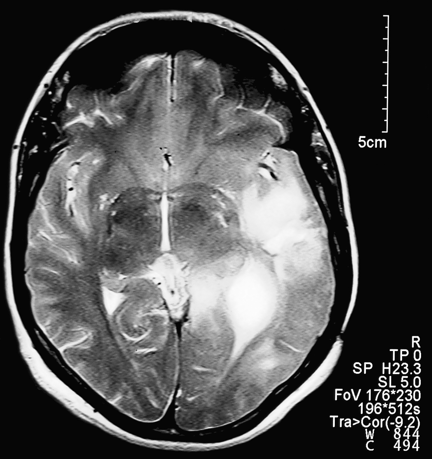 Brain with GBM (white areas)