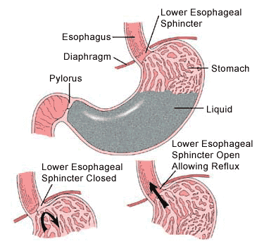 Faulty Sphincter Gerd Yourself For A Magnetic Solution Science 2 0