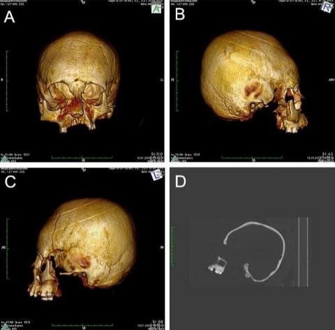 Artificial Cranial Deformation For Social Status Found In Croatia Skulls From 5th Century