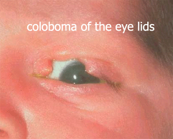 Coloboma affecting the eyelid