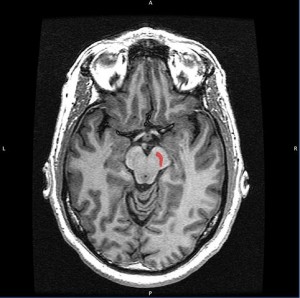 Europe Reinvestigates Fetal Cell Transplants For Parkinson’s Disease