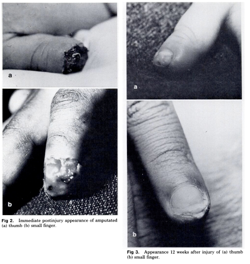  Nonoperative Management of Distal Fingertip Amputations in Children