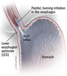 The Link Between Stomach Woes And Bad Breath