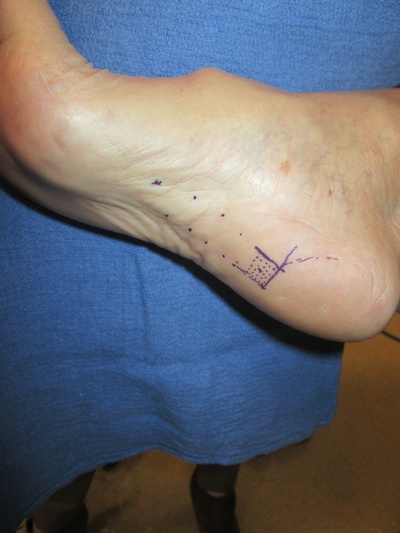 A Cure For Plantar Fasciitis May Be Fat Injections