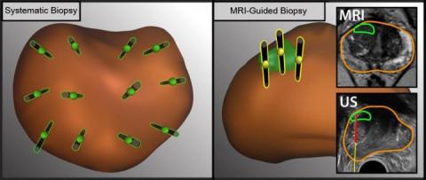 Hybrid MRI Approach Better Than Ultrasound For Detecting Prostate Cancer