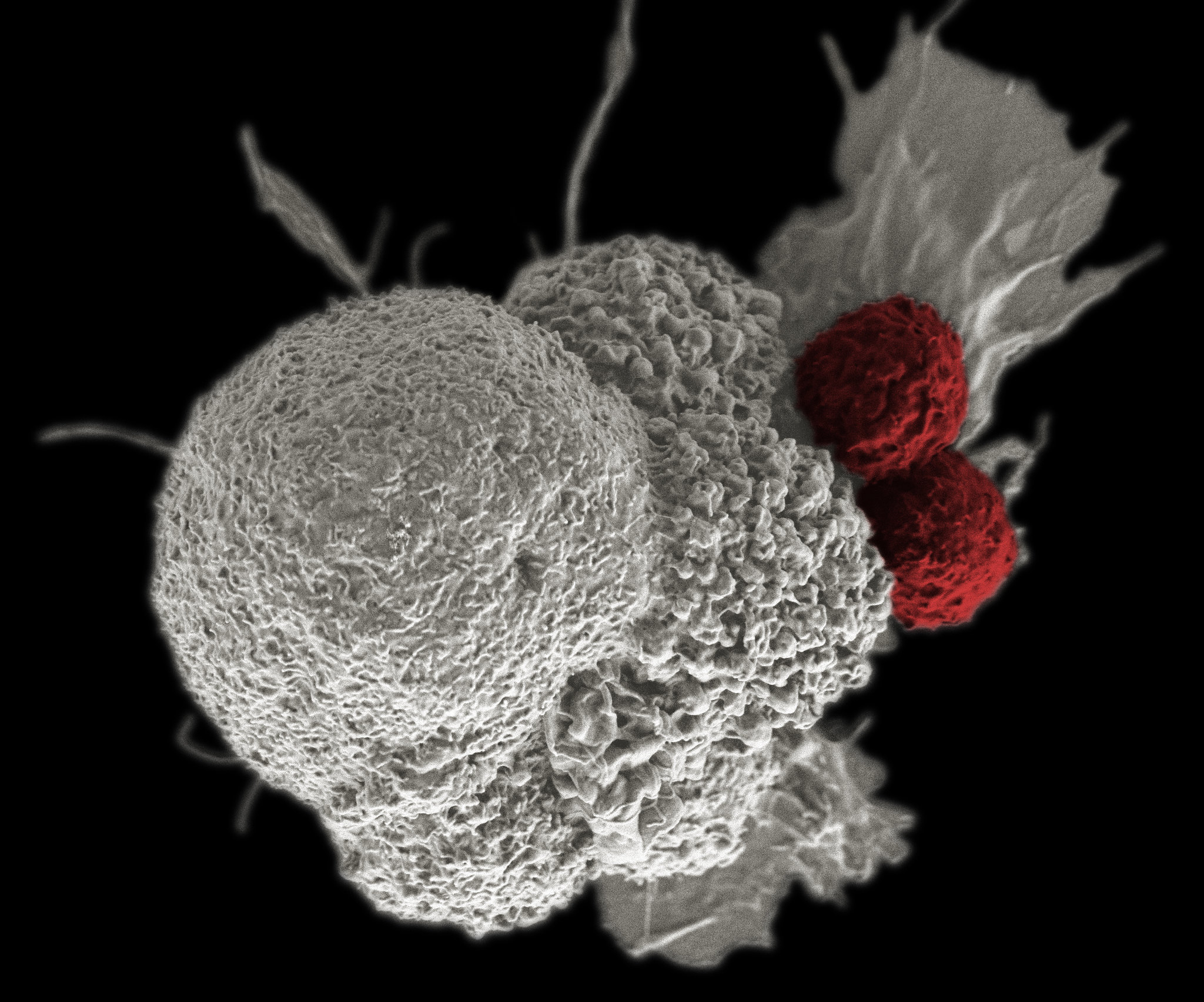 Genetically Edited White Blood Cells Are Already Helping Fight Cancer