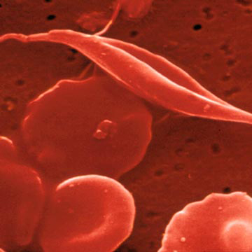 Gene Therapy Cures Sickle Cell In Mice