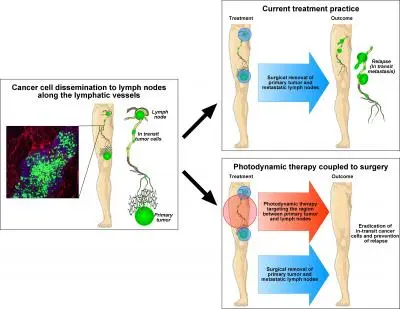 Targeting Intralymphatic Tumor Cells with photodynamic therapy Targeting Intralymphatic Tumor Cells with photodynamic therapy