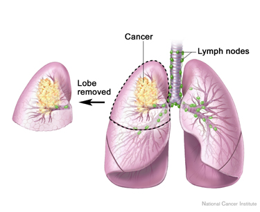 Radioactive 'Seeds' May Lead To Better Lung Cancer Prognosis