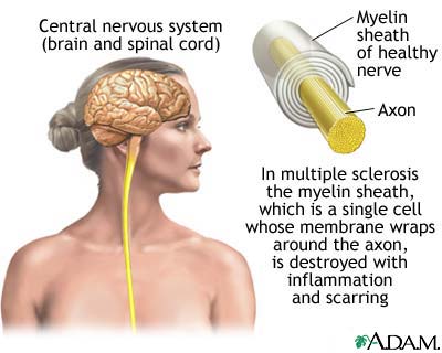 Study Proves Advances In Treatment For Multiple Sclerosis