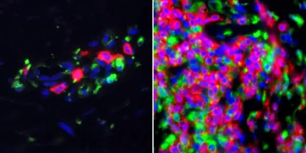 Sometimes It Is Lupus - And Here Is What Cancer Scientists Just Discovered