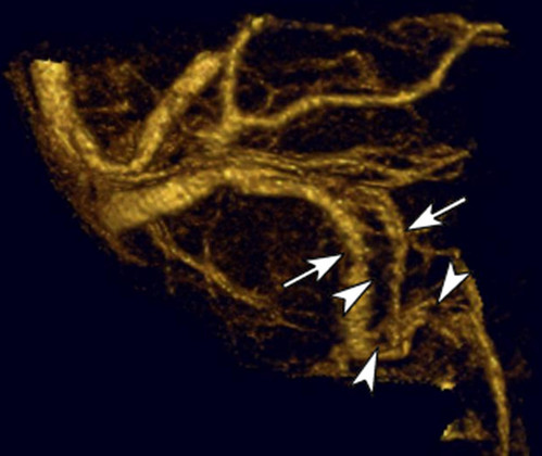 Combined Imaging Approach May Provide Better Identification Of Difficult-to-Diagnose Brain Clots